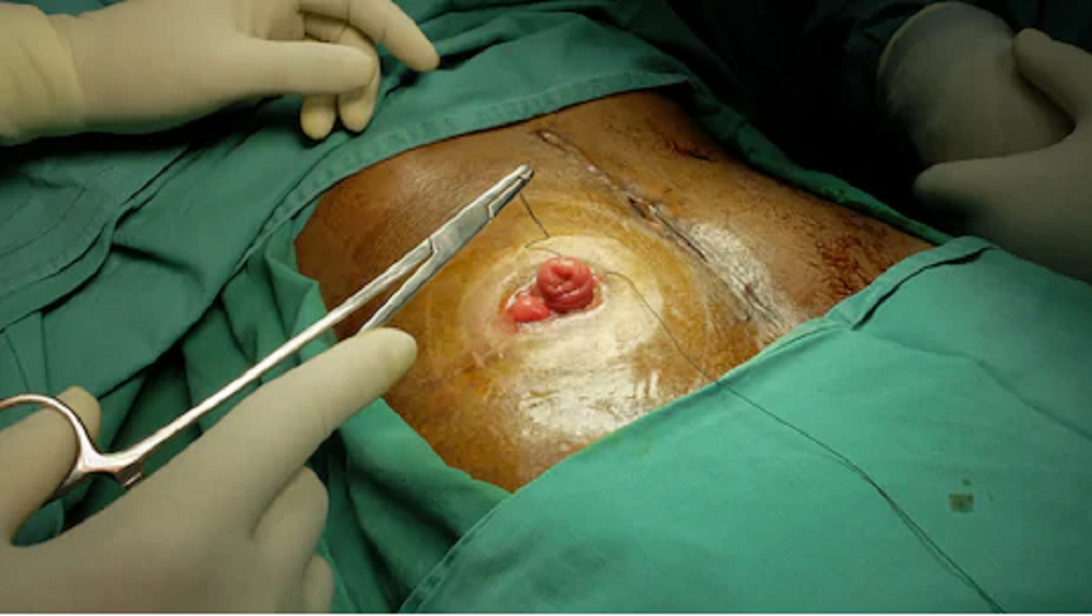 stoma 3web stoma 3web